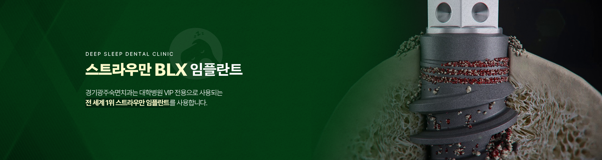 스트라우만 BLX 임플란트-경기광주숙면치과는 대학병원 VIP 전용으로 사용되는 전 세계 1위 스트라우만 임플란트를 사용합니다.