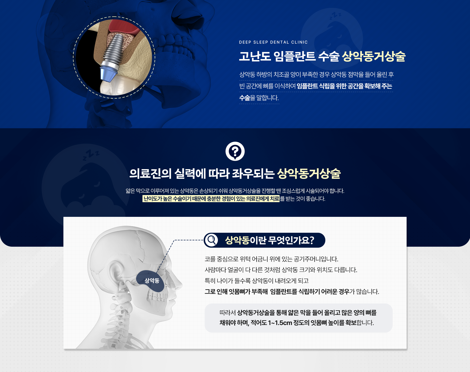 고난도 임플란트 수술 상악동거상술|의료진의 실력에 따라 좌우되는 상악동거상술