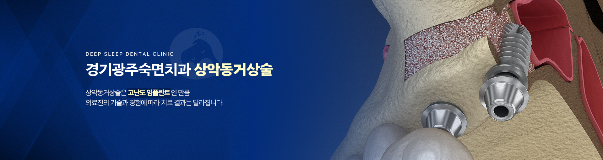 경기광주숙면치과 상악동거상술-상악동거상술은 고난도 임플란트인 만큼 의료진의 기술과 경험에 따라 치료 결과는 달라집니다.