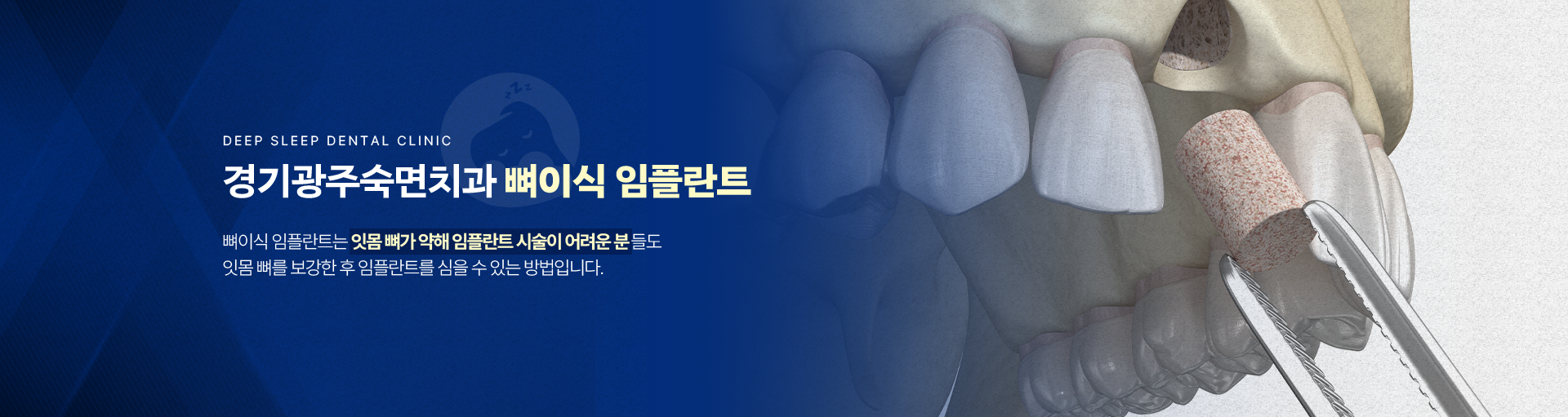 경기광주숙면치과 뼈이식 임플란트-뼈이식 임플란트는 잇몸 뼈가 약해 임플란트 시술이 어려운 분들도 잇몸 뼈를 보강한 후 임플란트를 심을 수 있는 방법입니다.