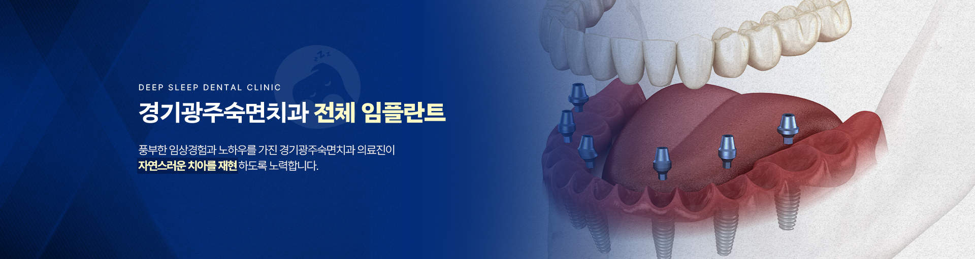 경기광주숙면치과 전체 임플란트-풍부한 임상경험과 노하우를 가진 경기광주숙면치과 의료진이 자연스러운 치아를 재현하도록 노력합니다.