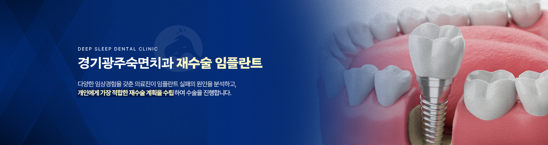 경기광주숙면치과 재수술 임플란트-다양한 임상경험을 갖춘 의료진이 임플란트 실패의 원인을 분석하고, 개인에게 가장 적합한 재수술 계획을 수립하여 수술을 진행합니다.