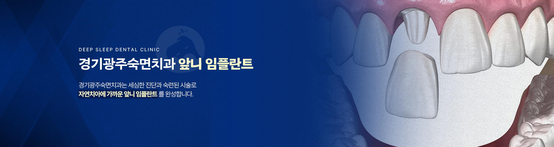 경기광주숙면치과 앞니 임플란트-경기광주숙면치과는 세심한 진단과 숙련된 시술로 자연치아에 가까운 앞니 임플란트를 완성합니다.