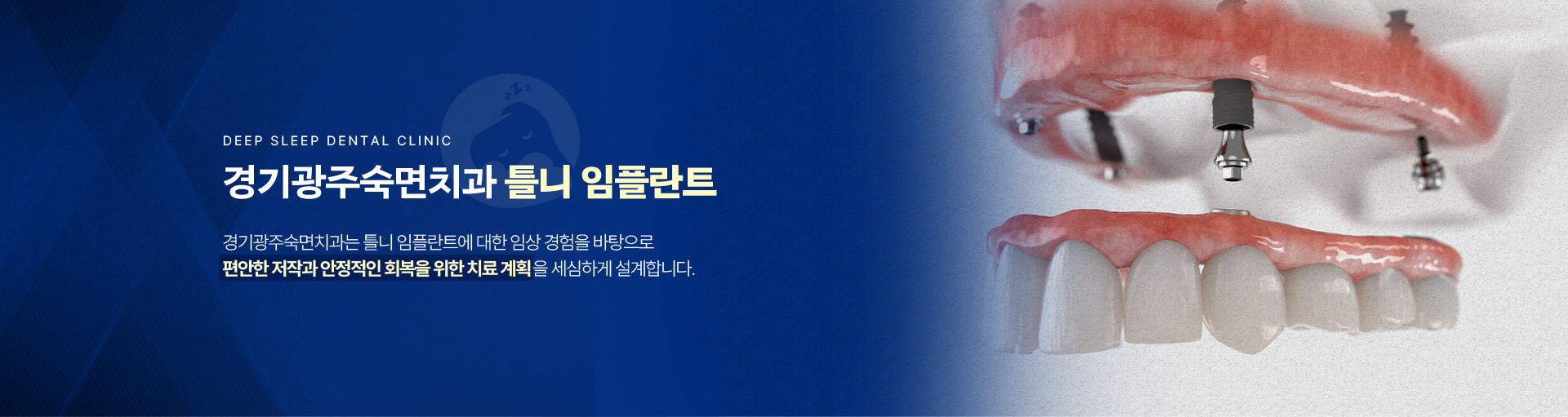 경기광주숙면치과 틀니 임플란트-경기광주숙면치과는 틀니 임플란트에 대한 임상 경험을 바탕으로 편안한 저작과 안정적인 회복을 위한 치료 계획을 세심하게 설계합니다.