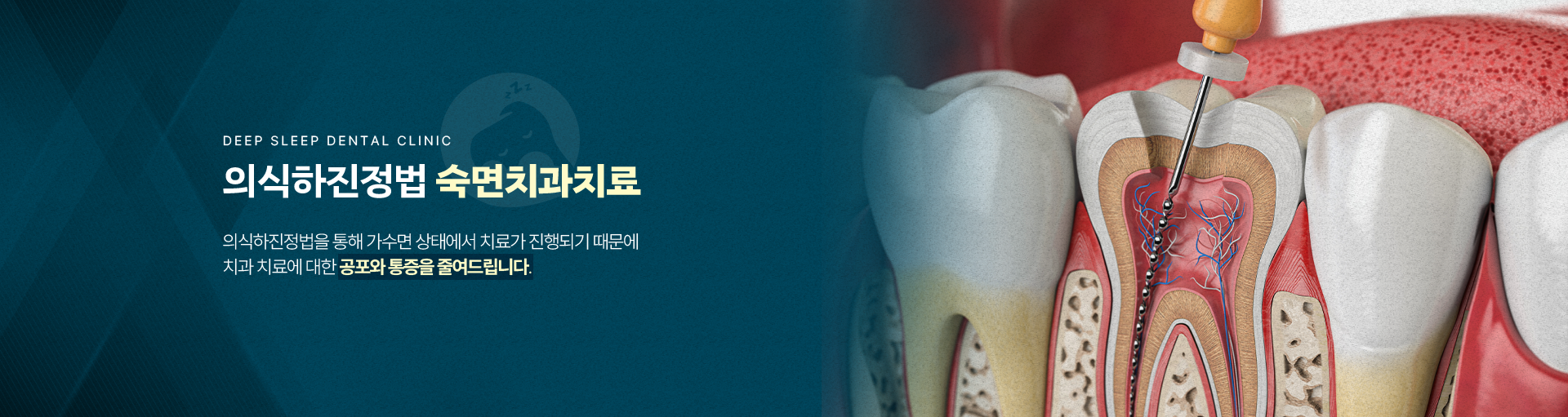 의식하진정법 숙면치과치료-의식하진정법을 통해 가수면 상태에서 치료가 진행되기 때문에 치과 치료에 대한 공포와 통증을 줄여드립니다.