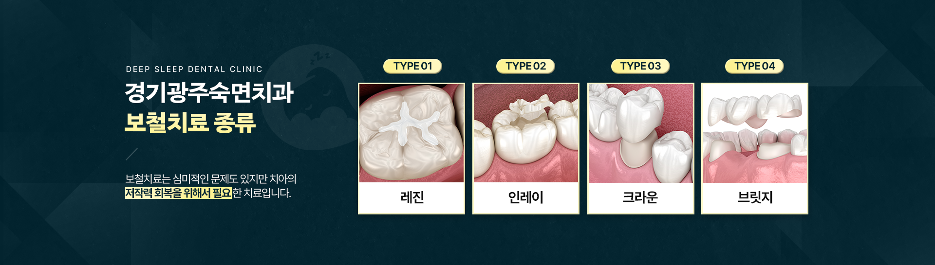 경기광주숙면치과 보철치료 종류-
                type 01.레진, type 02.인레이, type 03.크라운, type 04.브릿지