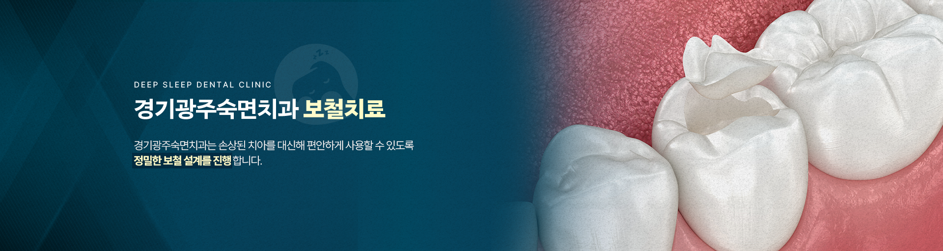 경기광주숙면치과 보철치료-경기광주숙면치과는 손상된 치아를 대신해 편안하게 사용할 수 있도록 정밀한 보철 설계를 진행합니다.