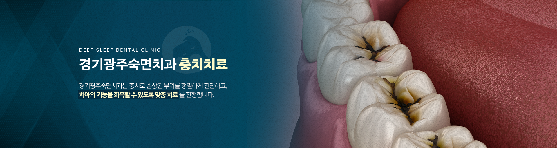 경기광주숙면치과 충치치료-경기광주숙면치과는 충치로 손상된 부위를 정밀하게 진단하고, 치아의 기능을 회복할 수 있도록 맞춤 치료를 진행합니다.