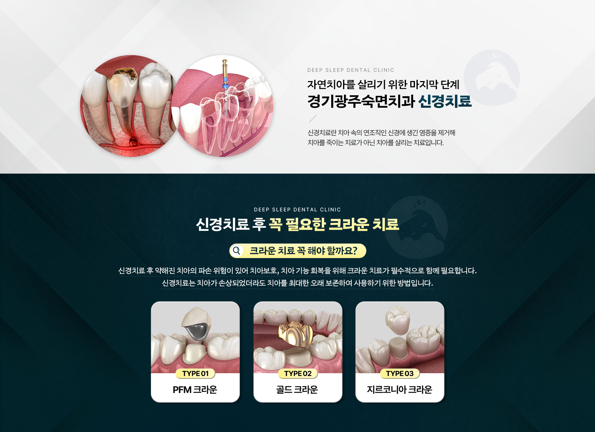 자연치아를 살리기 위한 마지막 단계 경기광주숙면치과 신경치료|
                신경치료 후 꼭 필요한 크라운 치료-.TYPE 01.PFM 크라운, TYPE 02.골드 크라운, TYPE 03.지르코니아 크라운