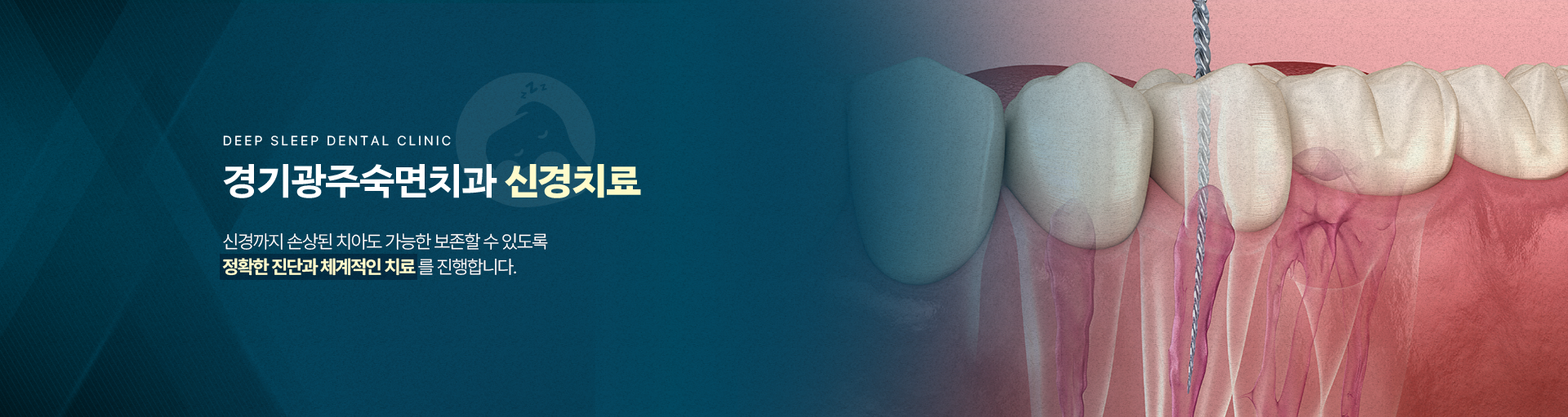 경기광주숙면치과 신경치료-신경까지 손상된 치아도 가능한 보존할 수 있도록 정확한 진단과 체계적인 치료를 진행합니다.