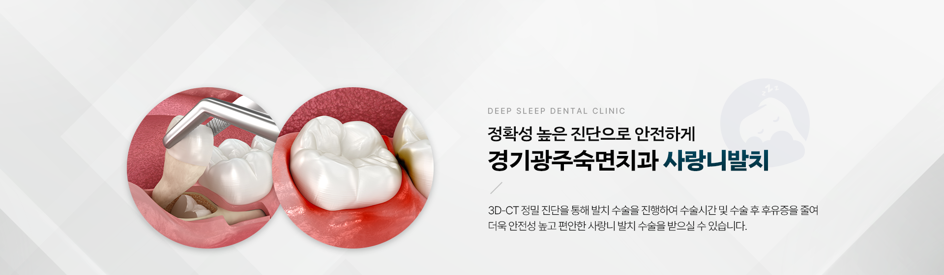 정확성 높은 진단으로 안전하게 경기광주숙면치과 사랑니발치 