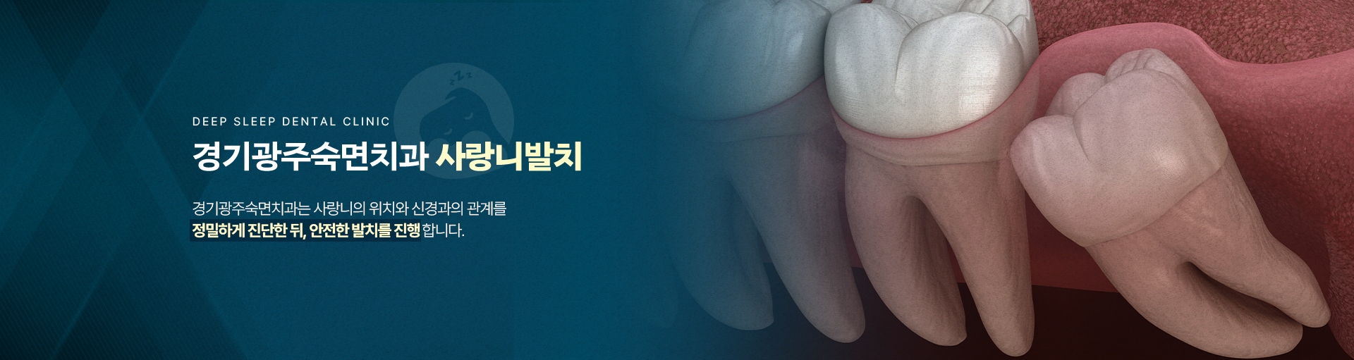 경기광주숙면치과 사랑니발치-경기광주숙면치과는 사랑니의 위치와 신경과의 관계를 정밀하게 진단한 뒤, 안전한 발치를 진행합니다.