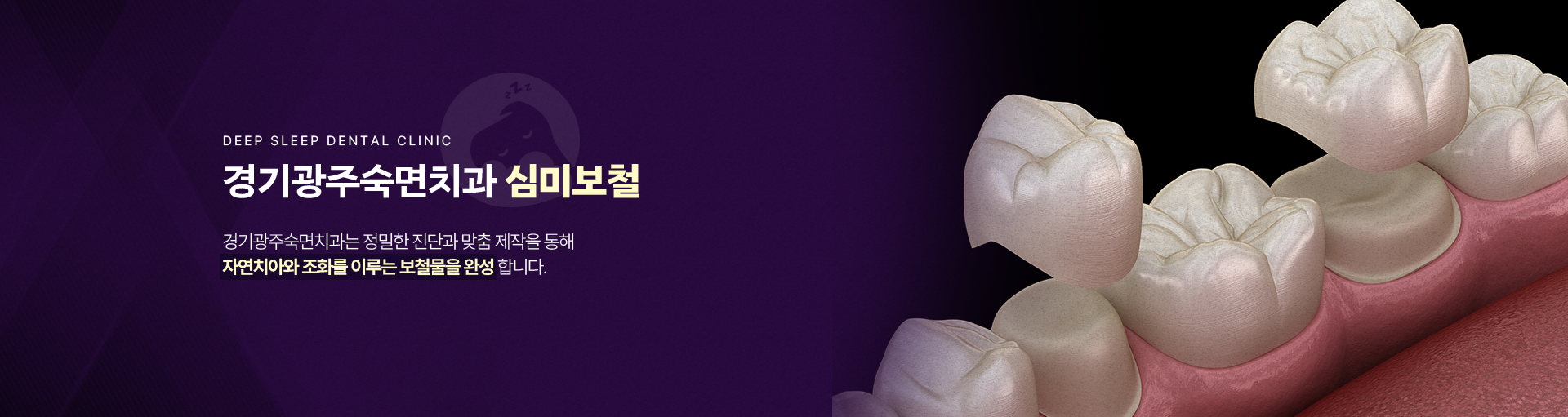 경기광주숙면치과 심미보철-경기광주숙면치과는 정밀한 진단과 맞춤 제작을 통해 자연치아와 조화를 이루는 보철물을 완성합니다.