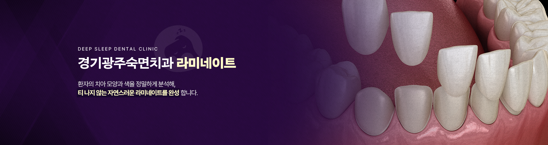경기광주숙면치과 라미네이트-환자의 치아 모양과 색을 정밀하게 분석해, 티 나지 않는 자연스러운 라미네이트를 완성합니다.