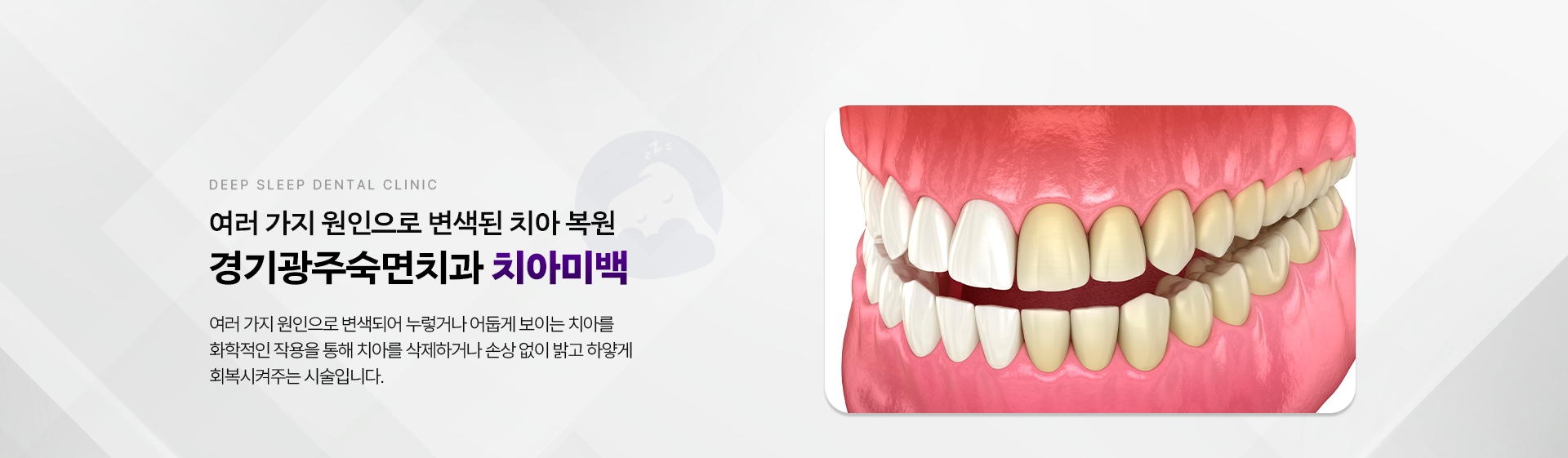 여러 가지 원인으로 변색된 치아 복원 경기광주숙면치과 치아미백