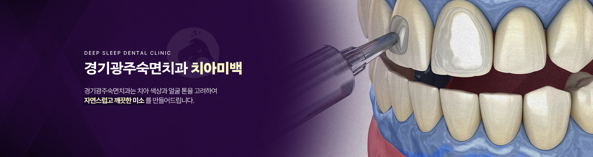 경기광주숙면치과 치아미백-경기광주숙면치과는 치아 색상과 얼굴 톤을 고려하여 자연스럽고 깨끗한 미소를 만들어드립니다.
