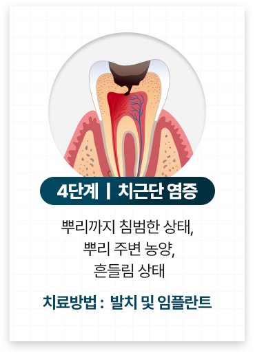 임플란트