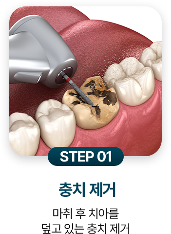 STEP 01.충치 제거