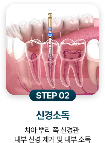 STEP 02.신경소독
