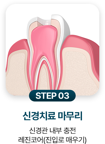 STEP 03.신경치료 마무리