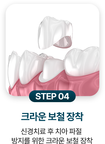 STEP 04.크라운 보철 장착