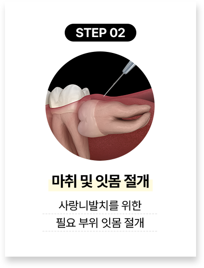 step 02.마취 및 잇몸 절개