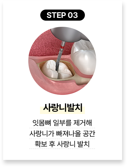 step 03.사랑니발치