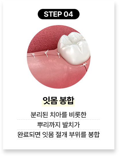 step 04.잇몸 봉합