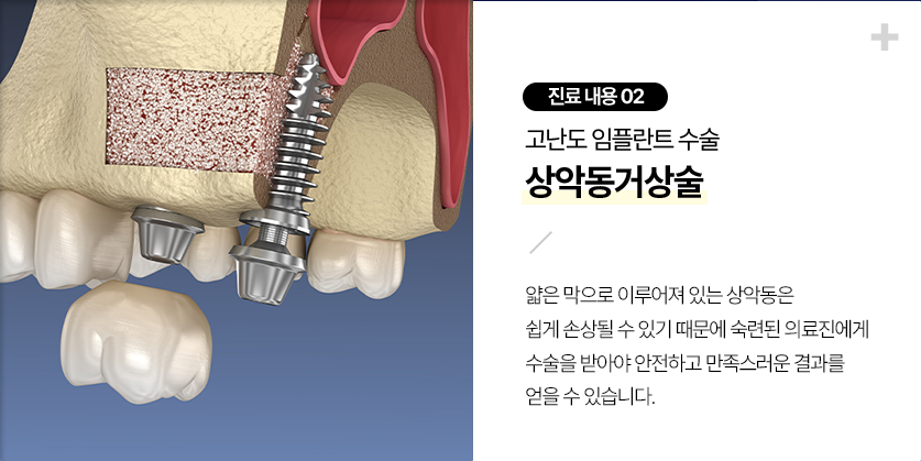 상악동거상술