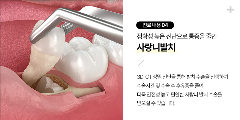 사랑니 발치