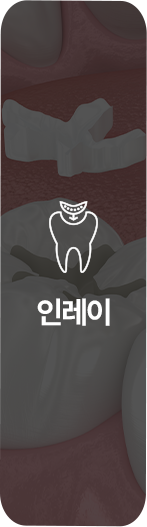 인레이