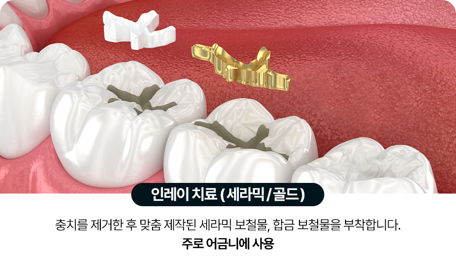인레이