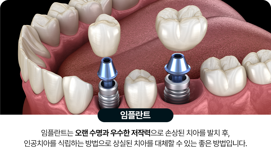 임플란트